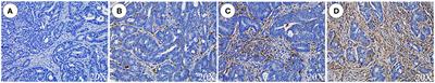 Invasion characteristics and clinical significance of tumor-associated macrophages in gastrointestinal Krukenberg tumors